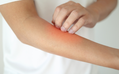 Animal Bites, Bug Bites, and Summer Skin Infections: What Hillsboro Families Should Know This Summer